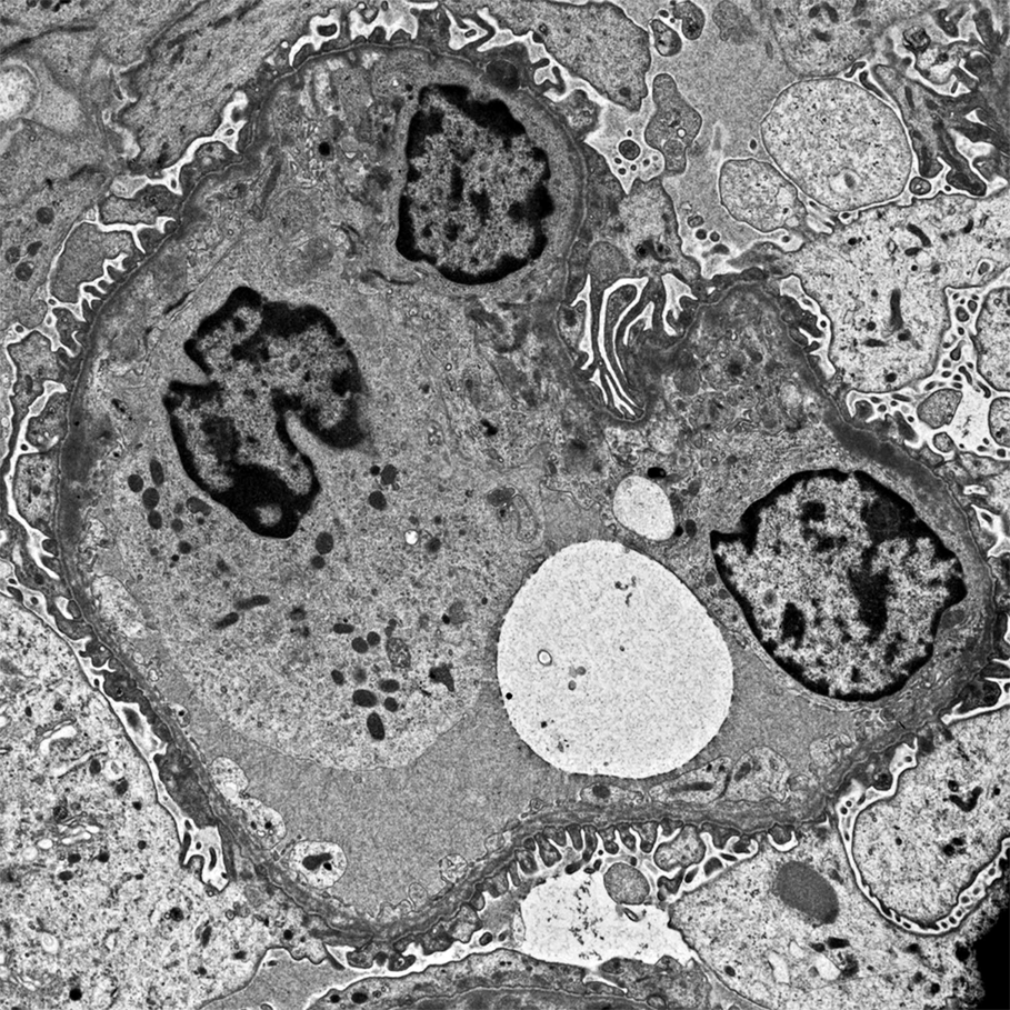 Ostre kłębuszkowe zapalenie nerek u dziewczynki z rodzinnym zespołem Alporta opis przypadku nohistochemicznego w obrębie kłębuszków nerkowych wykazano obecność ziarnistych złogów złożonych ze