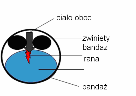 Ciało obce naleŝy umocować i osłonić jałowym opatrunkiem, i zgłosić się po pomoc opatrunek stabilizujący. ZŁAMANIA: Złamania naleŝy unieruchomić (2 sąsiednie stawy) przy uŝyciu: o szyn np.