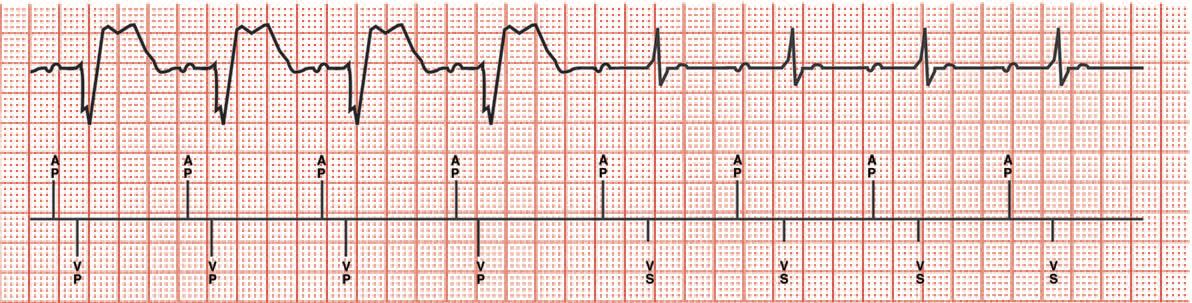 MEDTRONIC MVP: Switch from DDD(R) to AAI(R) pozytywna kontrola przewodzenia AV (1 pobudzenie) Switch to AAI (R) AV Conduction