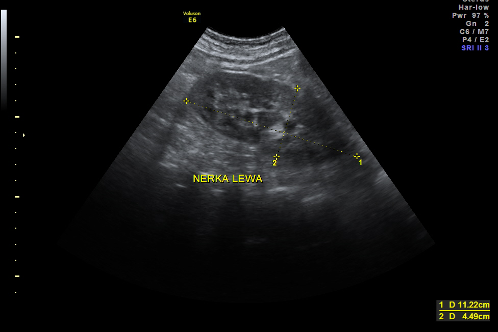 Rycina 5 Obraz prawej nerki w badaniu USG po zabiegu operacyjnym. Right kidney in USG evaluation after surgery. Rycina 6 Obraz lewej nerki po zabiegu operacyjnym.