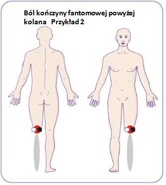 Ból kooczyny fantomowej powyżej kolana reprezentuje czerwona strefa bólu.