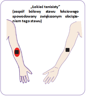 Dwie elektrody umieścid należy z przodu nogi, natomiast dwie kolejne z tyłu nogi zgodnie z diagramem przedstawionym obok.