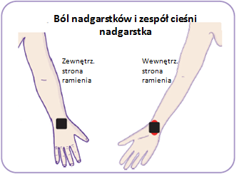 Ból łokcia golfisty reprezentuje czerwona strefa bólu. Czarne kwadraty wewnątrz tej strefy reprezentują parę elektrod.