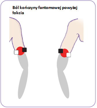 Ból kooczyny fantomowej poniżej łokcia reprezentuje czerwona strefa bólu. Czarne i białe kwadraty wewnątrz tej strefy reprezentują 2 pary elektrod.