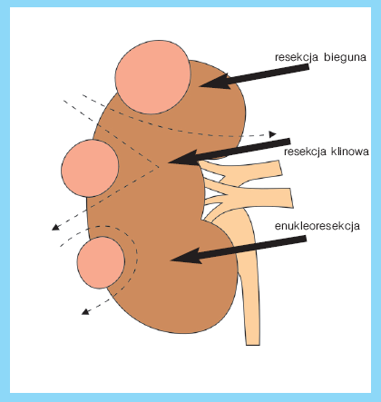 Rysunek 18 Zabiegi organooszczędne na nerce Źródło: Z. Kwias, A. Antczak, W. Cieślikowski, T. Stachowski,,P. Kalwas, P. Milecki., Nowotwory nerek, Współczesna Onkologia, 2002, vol.6; 9 (620-626). 4.