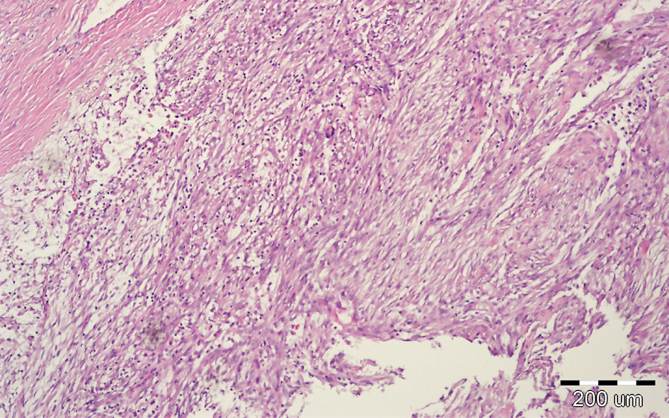 Opis przypadku ﬁbroblastoma desmoplasticum u młodego mężczyzny Wstęp Fibroblastoma desmoplasticum (collagenous ﬁbroma) jest łagodnym guzem tkanek miękkich.