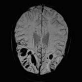 syngo SWI (Susceptibility Weighted Imaging) Unikatowe dla firmy Siemens techniki sekwenczjne dla obrazowania zależnego od wrażliwości Wizualizacja lokalnych zmian pola magnetycznego związanych