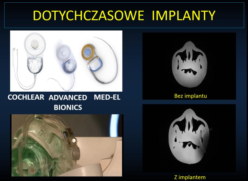 Podczas tego badania stają się dostępne centralne struktury mózgu w tym droga słuchowa. Jednakże tego typu techniki wciąż nie możemy użyć do badania osób z implantem słuchowym.