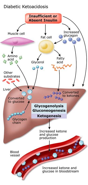 Kwasica ketonowa (DKA) w cukrzycy www.drugswell.com http://dtc.