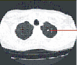 Tomografia komputerowa CT (computed tomography ) Po lewo 1mm plaster spiralnej CT ze środkowego obszaru klatki piersiowej