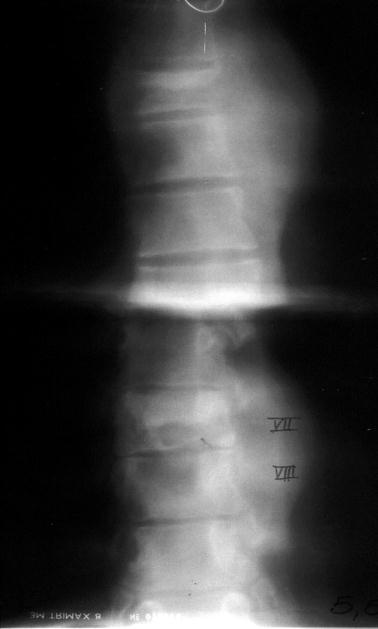 Gruźlica kostno-stawowa - zapalenie swoiste - wtórne, krwiopochodne - przewlekłe Najczęściej umiejscawia się w kręgosłupie: - w odcinku piersiowym - obejmuje tarczę międzykręgową i sąsiadujące trzony