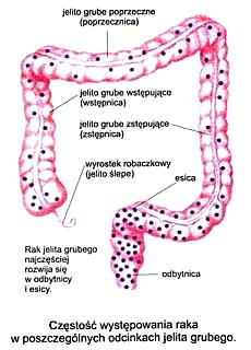 Rak jelita grubego u chorych na NZJ Najpoważniejszy odległy skutek WZJG Bartnik W. Gastroenterol Pol 2007 W ch.