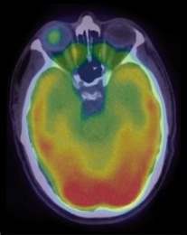 3. Nakładanie obrazów PET CT