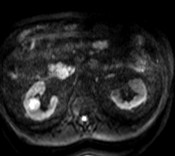 Aisen1 AJR 2010; 194:438-445 The role of the ADC value in the characterisation of renal carcinoma by diffusion-weighted MRI B PAUDYAL, MD,