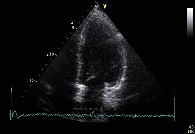 Epidemia niewydolności serca Massie B.M., Shah N.B.: The heart failure epidemic: magnitude of the problem and potential mitigating approaches. Curr. Opin. Cardiol. 1996; 11: 221-226. EF <30% 25-74 rż.