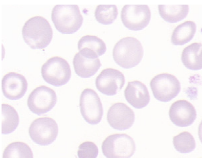 Ryc. 3. Pierścień Cabota Ryc. 4. Rozmaz krwi obwodowej w przypadku Ryc. 5. Przypadek talasemii beta. Wynik z analizatora XE.