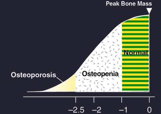 Definicja WHO (do 2005r) MC zawartość mineralna kości (DEXA) MD gęstość mineralna kości Norma BMC lub BMD > 1 SD poniżej wartości normy dla młodych osób (T-score) Osteopenia - BMC lub BMD = 1-2,5