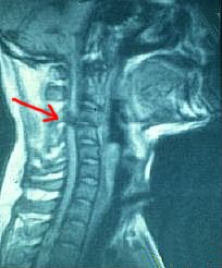(ang. Spinal Cord
