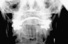 Fig. 1. Completed applicator with additional posterior train of seeds to treat adjacent soft palate. Fig. 2. Lateral X-ray of dummy applicator. Fig. 3.