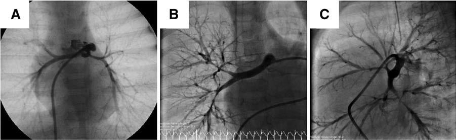 Arteriografia - obwodowe zwężenia tętnic płucnych Cardiovascular Disease in
