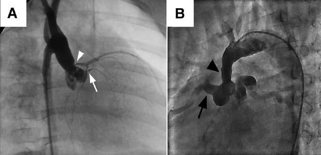 Nadzastawkowe zwężenie aorty na długim odcinku z poszerzeniem naczyń wieńcowych