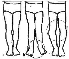 Wady klatki piersiowej a-kurza, b- lejkowata. Ustawienie kolan a - kolana proste, b - kolana koślawe, c - kolana szpotawe.