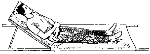 uniesienie podłoża na którym leży poszkodowany pozycja Trendelemburga Ułożenie pacjenta z podejrzeniem urazu brzucha Stosuje się ją w transporcie osób z ostrym urazem brzucha (powstały w wyniku urazu