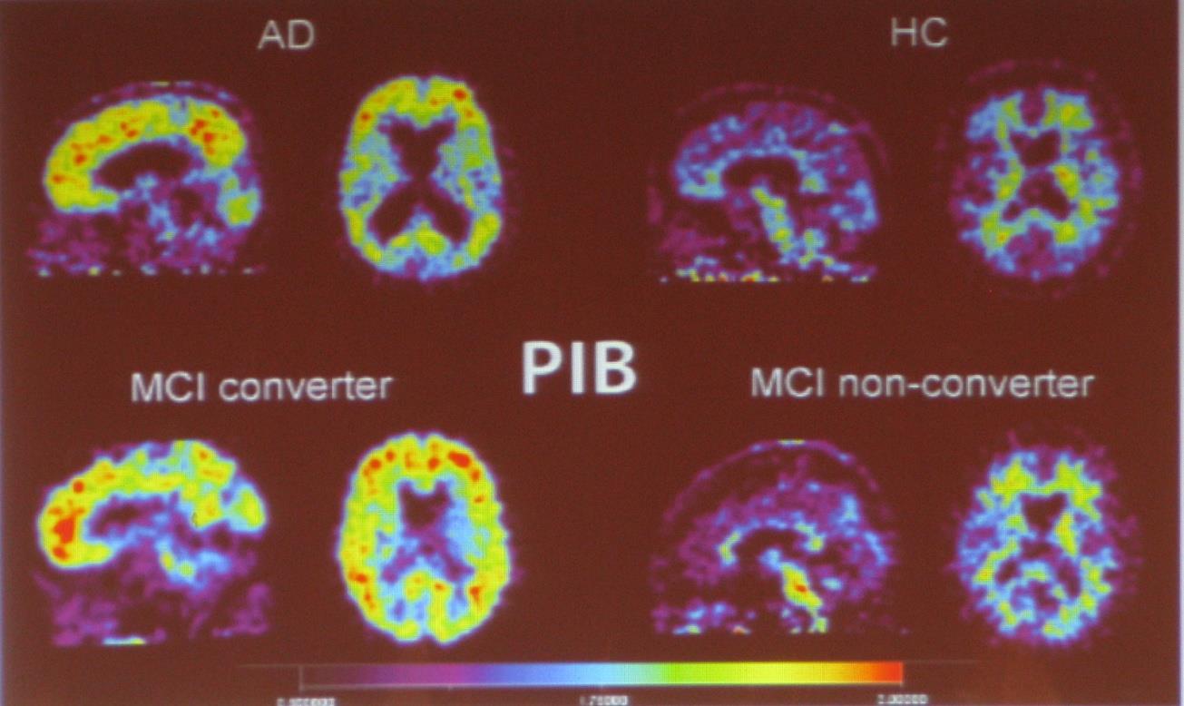 In vivo assesment of amyloid load of the brain 11 C-PIB uptake (compound combining with amyloid used in PET) correlates with volumetrically assessed brains in patients with mildly and moderately