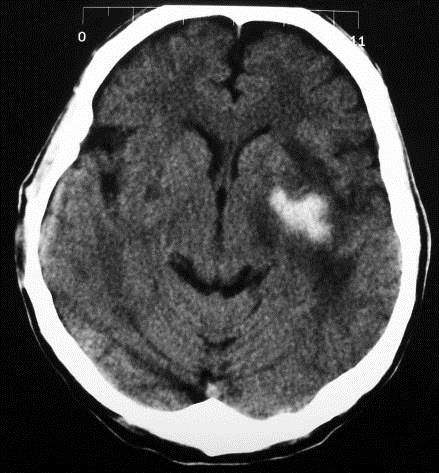 Krwotok wewnątrzczaszkowy objawy w TK Faza podostra kilka dni ognisko hyperdensyjne niejednorodne o malejącej gęstości w ciągu 4 dni