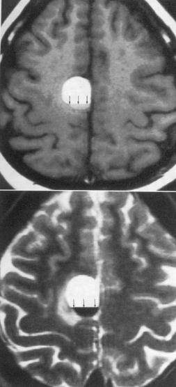 Krwotok wewnątrzczaszkowy objawy w RM faza ostra 0 2 dni oksyhemoglobina i potem deoxy Hb w wynaczynionych erytrocytach (nie posiada własności paramagnetycznych) wysoki