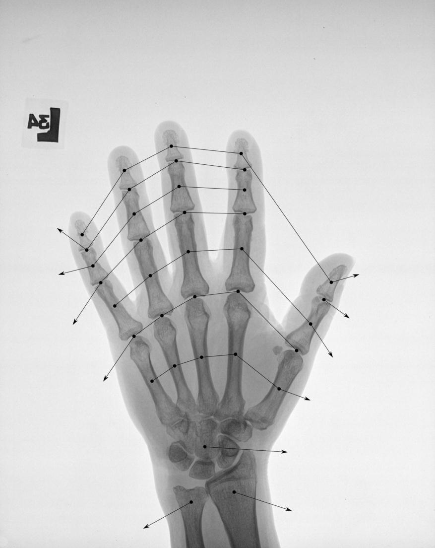 Staw międzypaliczkowy dalszy Kciuk Mały palec Palec serdeczny Palec środkowy Palec wskazujący (ang.