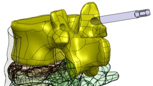 Wirtualna stabilizacja kręgosłupa człowieka po złamaniu kompresyjnym 199 Otwory w trzonach kręgów wykonano poprzez wykorzystanie geometrii unieruchomionych śrub (rys. 8).