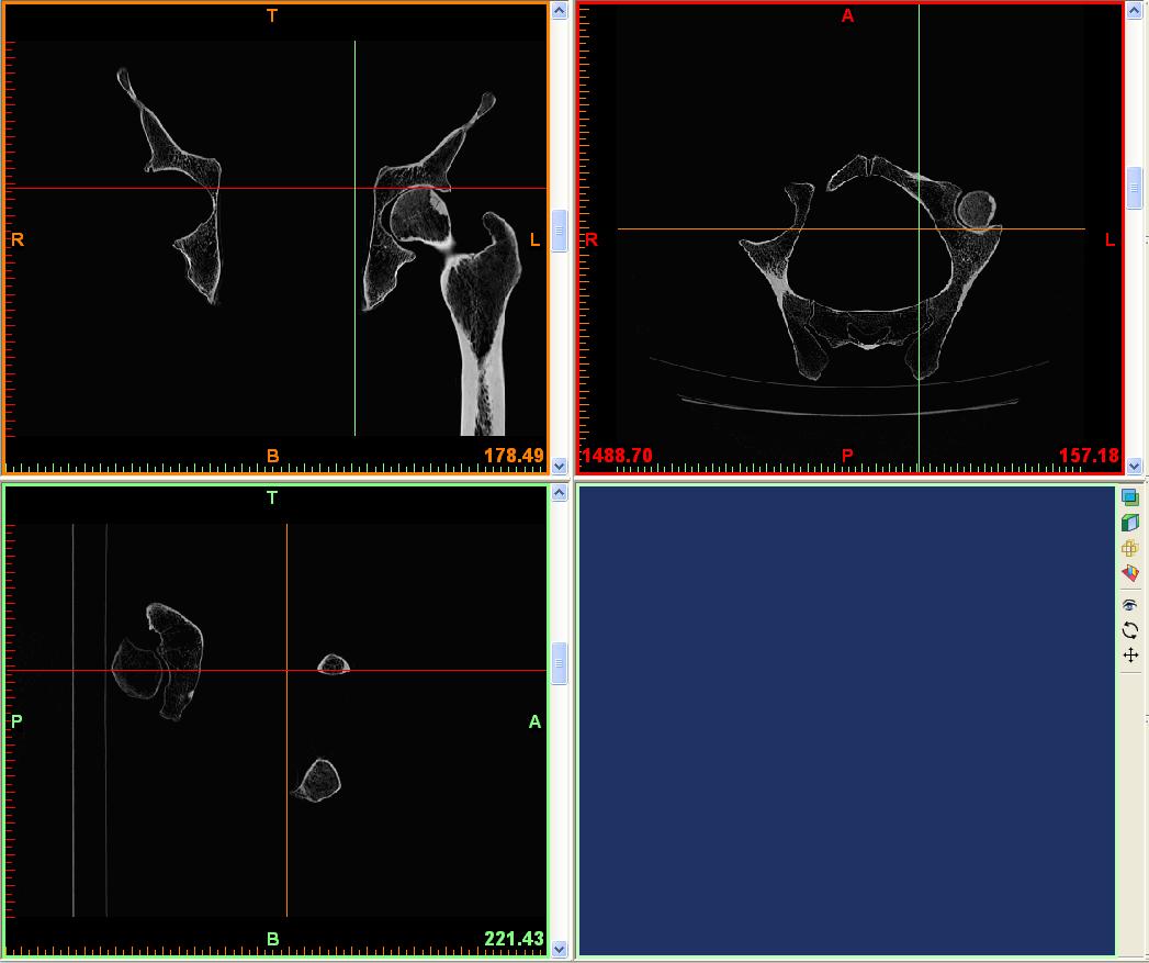 modelu geometrycznego oraz tworzenie modelu numerycznego. Do budowy modelu geometrycznego stosuje się obecnie przetworzone dane tomograficzne lub pochodzące z rezonansu magnetycznego.