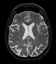 Diagnostyka medyczna przykłady W4 Tomografia rentgenowska - pozawala wykryć guzy, obrazować dobrze widoczne róŝnice, płyn CSF, kości, tkankę miękką, lub słabo