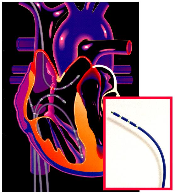 serca EKG I II III