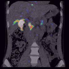 S 69 LYS40-(AHX-HYNIC)NH 2-99m Tc]EXENDIN-4 jako potencjalny radiofarmaceutyk do diagnostyki insulinoma.