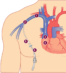Zakładanie dostępu centralnego Zakończenie cewnika w obszarze 1/3 dolna część żyły głównej górnej 1/3 górna część prawego przedsionka