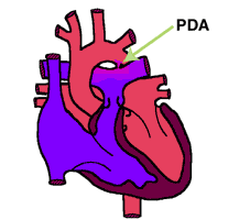 PDA - zamkni cie