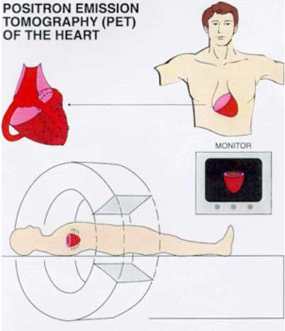 5.2. PET (Positron Emission Tomography) PET to pozytonowa emisyjna tomografia komputerowa. Rys. 12.