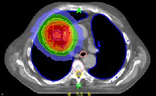 PET/CT - planowanie radioterapii CT