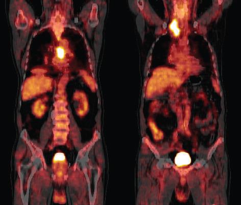 OCENA ROZLEGŁOŚCI PET w diagnostyce raka przełyku Rak płaskonabłonkowy przełyku. Obraz PET/CT tułowia w projekcji czołowej.