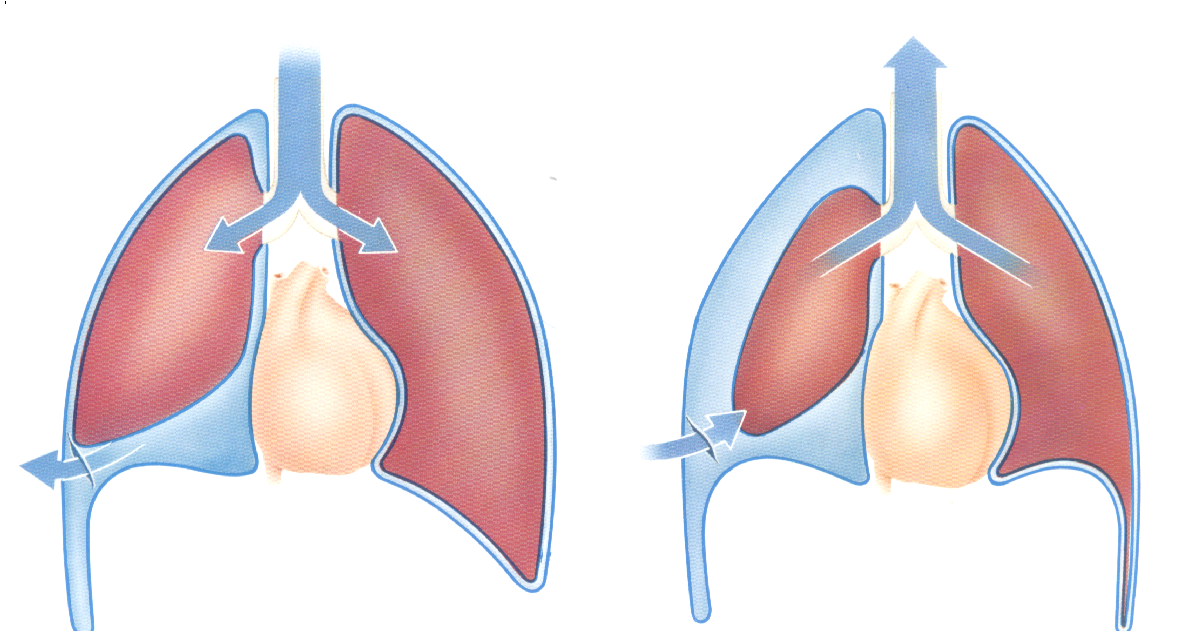 Odma opłucnowa obecność powietrza w opłucnej Odma opłucnowa