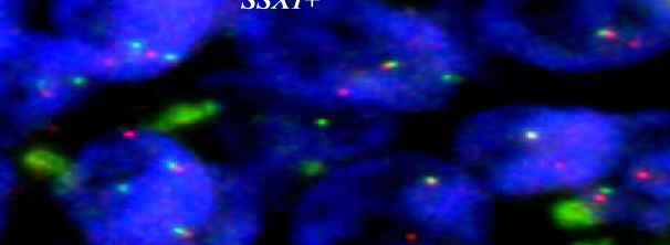 44 Mariola Iliszko Ryc. 11. Jądra interfazowe komórek guza mięsaka maziówkowego jednofazowego wybarwione dwukolorową techniką FISH z zastosowaniem sondy genu SSX1.