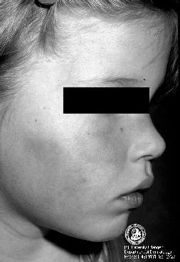 Erythema infectiosum Rumień zakaźny parwowirus B 19 (wirus DNA) Parvoviridae zakaŝenie droga niejasną, prawdopodobnie kropelkową, pokarmową oraz przetaczanie krwi zaraźliwość okres nieznany okres