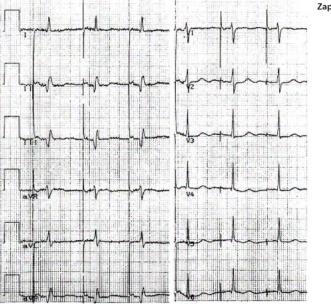 Stymulacja komory - V (ventricle) Pierwsza litera kodu V - układ posiada jedną elektrodę stymulującą w prawej komorze.