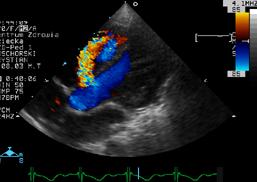 Wywiad i badanie przedmiotowe Pomiar RR tętniczego na 4 kończynach oraz SAT Morfologia (w razie wątpliwości) EKG wstępne badanie diagnostyczne pomimo małej czułości i specyficzności w rozpoznawaniu