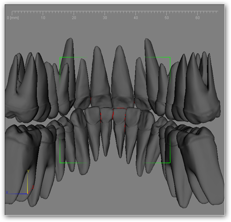 5.3. Widok kolizji "Widok kolizji" umożliwia zaobserwowanie punktów w których zęby stykają się ze sobą. Punkty styku widoczne są na czerwono.