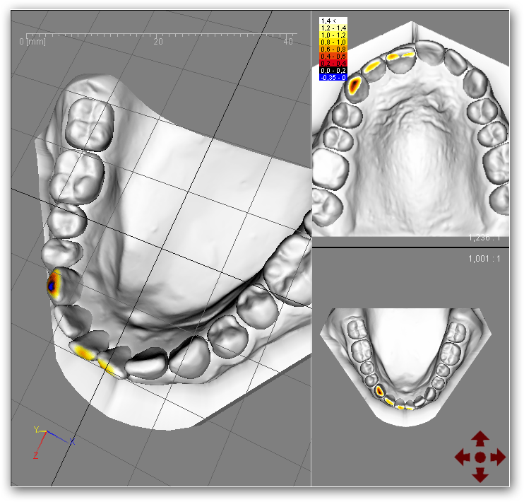 5.4. Widok okluzogramu "Widok okluzogramu" umożliwia obserwację odegłości między punktami powierzchni przeciwstawnych zębów. Odległości prezentowane są w postaci kolorów.