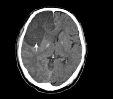 TK głowy udar niedokrwienny mózgu Zapobieganie Leczenie przeciwkrzepliwe doustnymi antykoagulantami zmniejsza o 60-80% częstość powikłań zakrzepowo-zatorowych U każdego chorego z AF należy ocenić