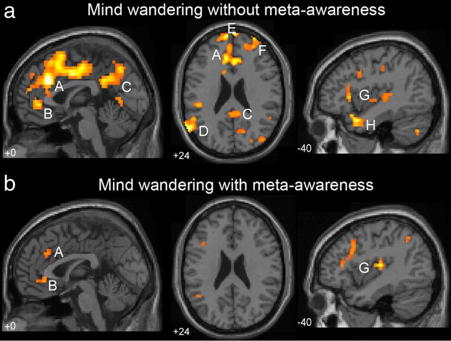 Wiedza z fmri to dla neurochirurgii nieoceniona pomoc przy planowaniu jak najbardziej optymalnych zabiegów